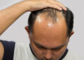 Hair loss