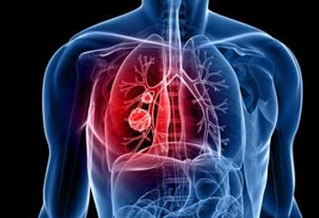 Lung cancer