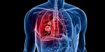 Lung cancer