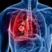 Lung cancer
