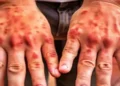 Psoriasis likely to affect men twice