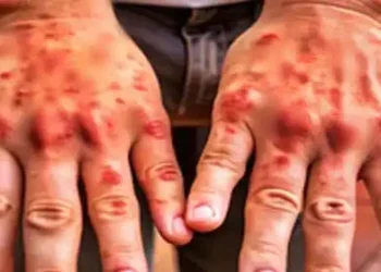 Psoriasis likely to affect men twice